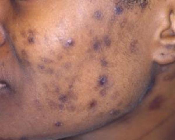 skin injury inflammation hyperpigmentation